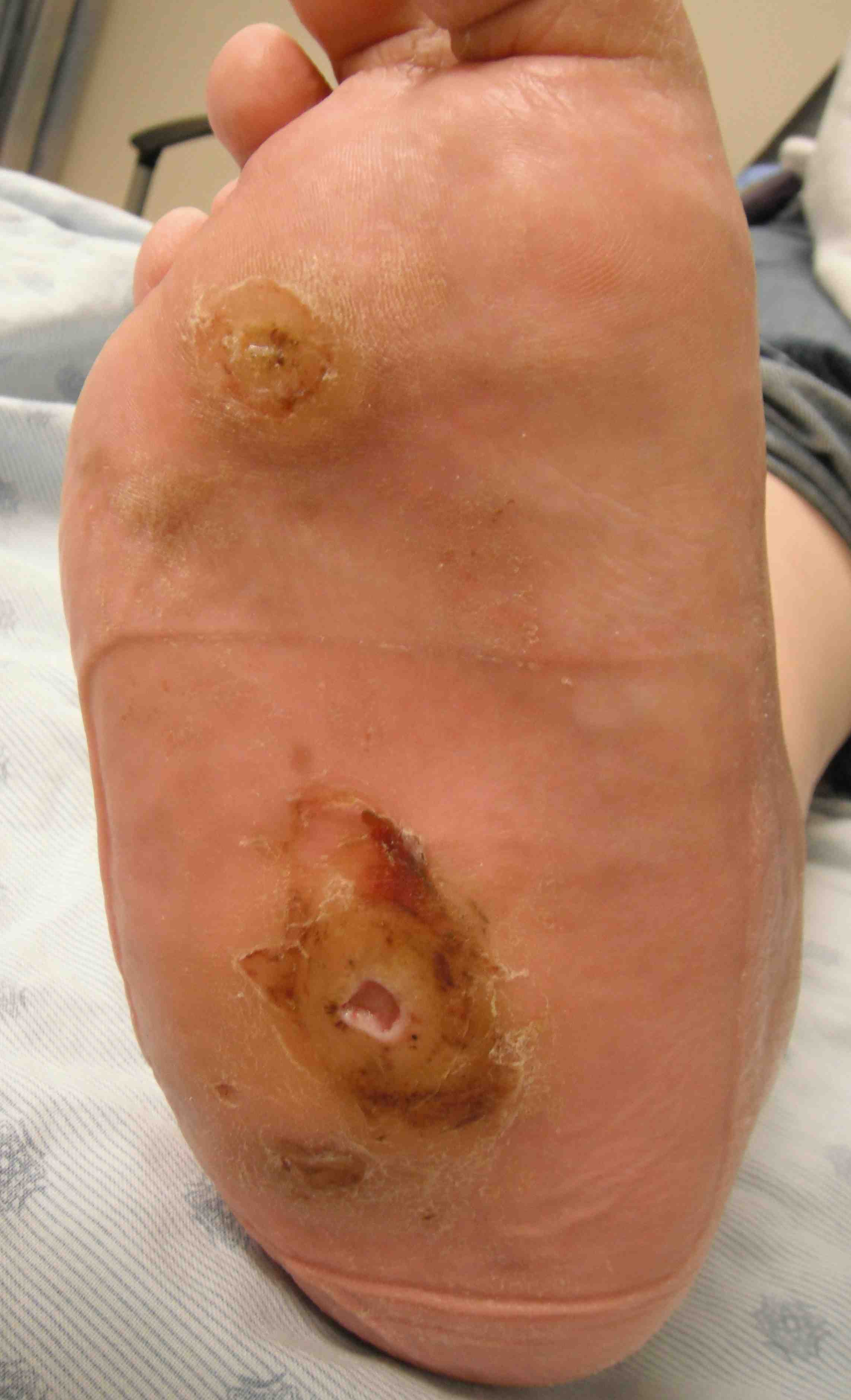 Neuropathic Midfoot Ulcers